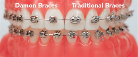 bracket damon metal|traditional braces vs damon.